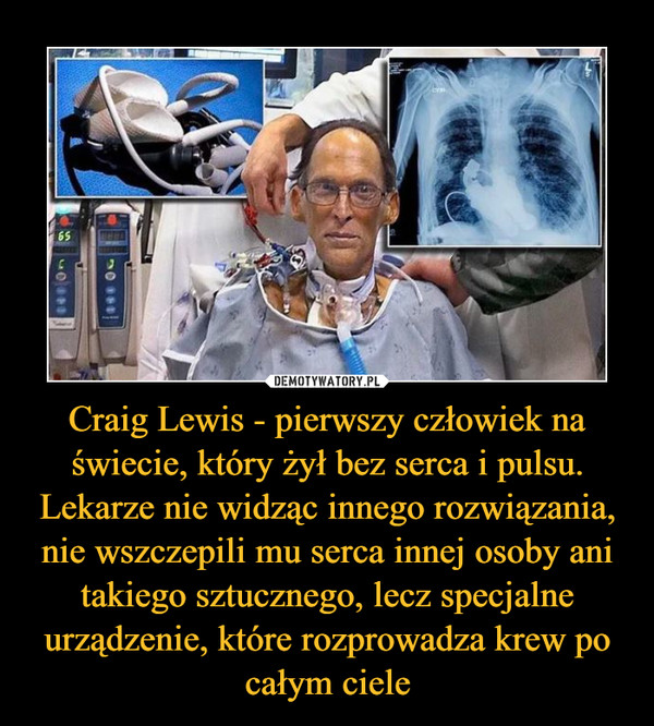 Craig Lewis - pierwszy człowiek na świecie, który żył bez serca i pulsu. Lekarze nie widząc innego rozwiązania, nie wszczepili mu serca innej osoby ani takiego sztucznego, lecz specjalne urządzenie, które rozprowadza krew po całym ciele