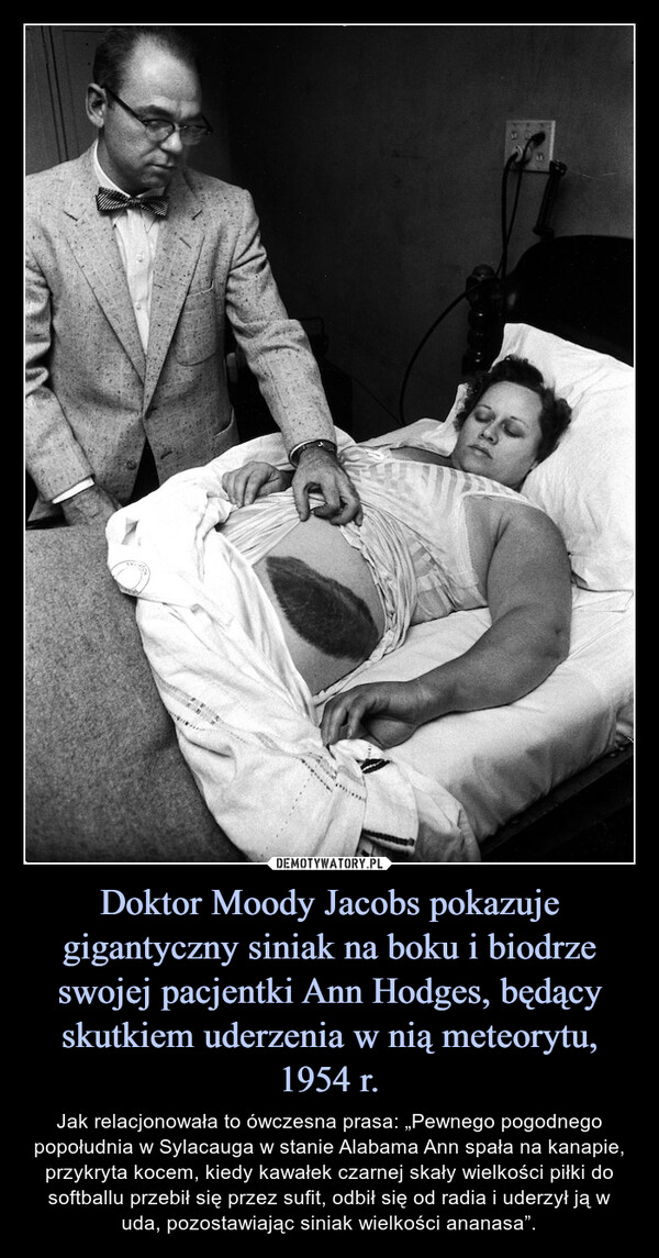 Doktor Moody Jacobs pokazuje gigantyczny siniak na boku i biodrze swojej pacjentki Ann Hodges, będący skutkiem uderzenia w nią meteorytu, 1954 r. – Jak relacjonowała to ówczesna prasa: „Pewnego pogodnego popołudnia w Sylacauga w stanie Alabama Ann spała na kanapie, przykryta kocem, kiedy kawałek czarnej skały wielkości piłki do softballu przebił się przez sufit, odbił się od radia i uderzył ją w uda, pozostawiając siniak wielkości ananasa”. 