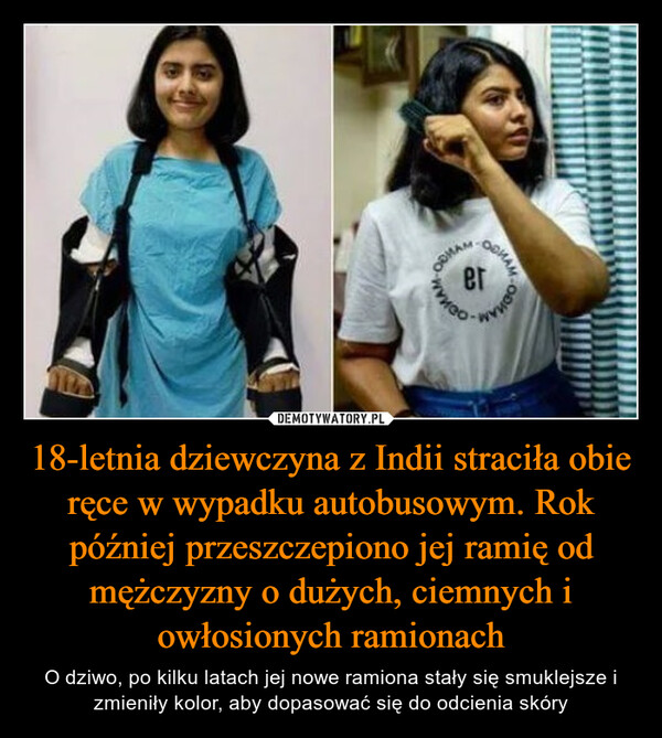 18-letnia dziewczyna z Indii straciła obie ręce w wypadku autobusowym. Rok później przeszczepiono jej ramię od mężczyzny o dużych, ciemnych i owłosionych ramionach – O dziwo, po kilku latach jej nowe ramiona stały się smuklejsze i zmieniły kolor, aby dopasować się do odcienia skóry 