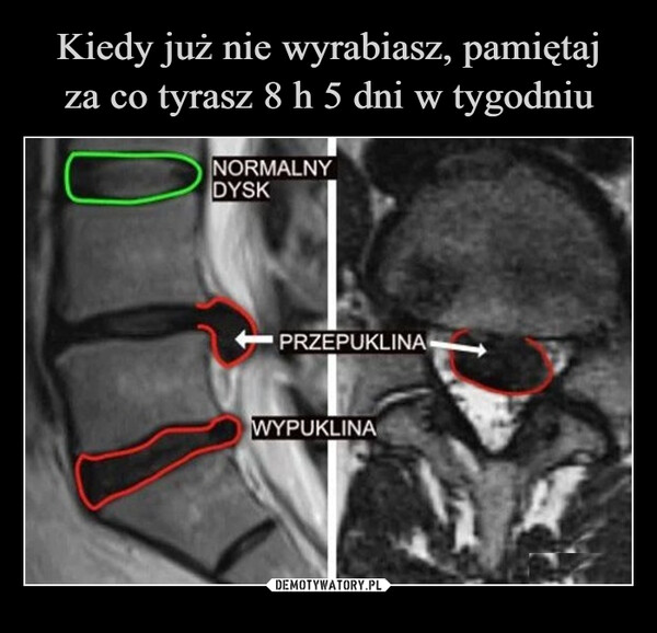  –  NORMALNYDYSKPRZEPUKLINAWYPUKLINA